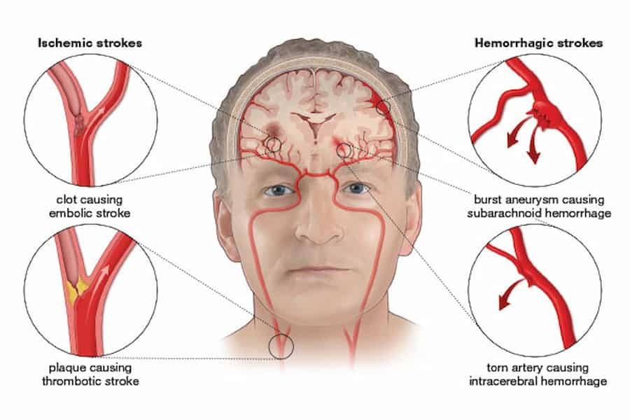 آگاهی از علائم هشدار دهنده سکته مغزی و اهمیت واکنش سریع